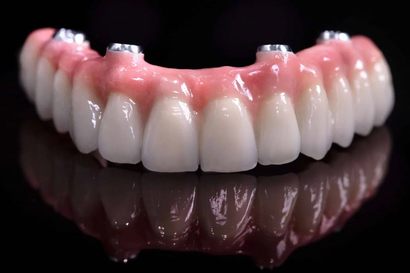 Full-arch All-on-4 implant bridge, replacing a whole arch of missing teeth on just four implants for a fixed, natural-looking smile
