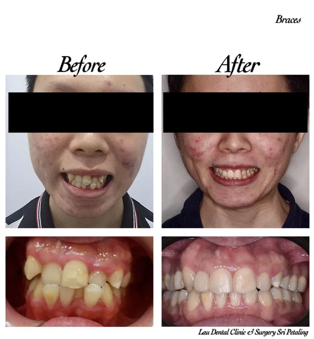 Braces before and after, resolving a crossbite and crowded teeth to give a properly aligned upper and lower arch