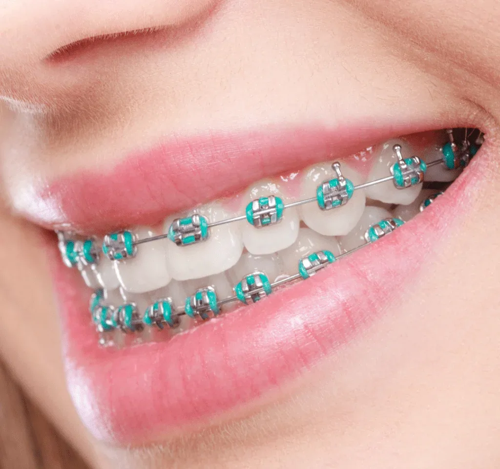 Conventional metal braces with coloured elastic ligatures, the proven and most affordable way to correct crowded or crooked teeth
