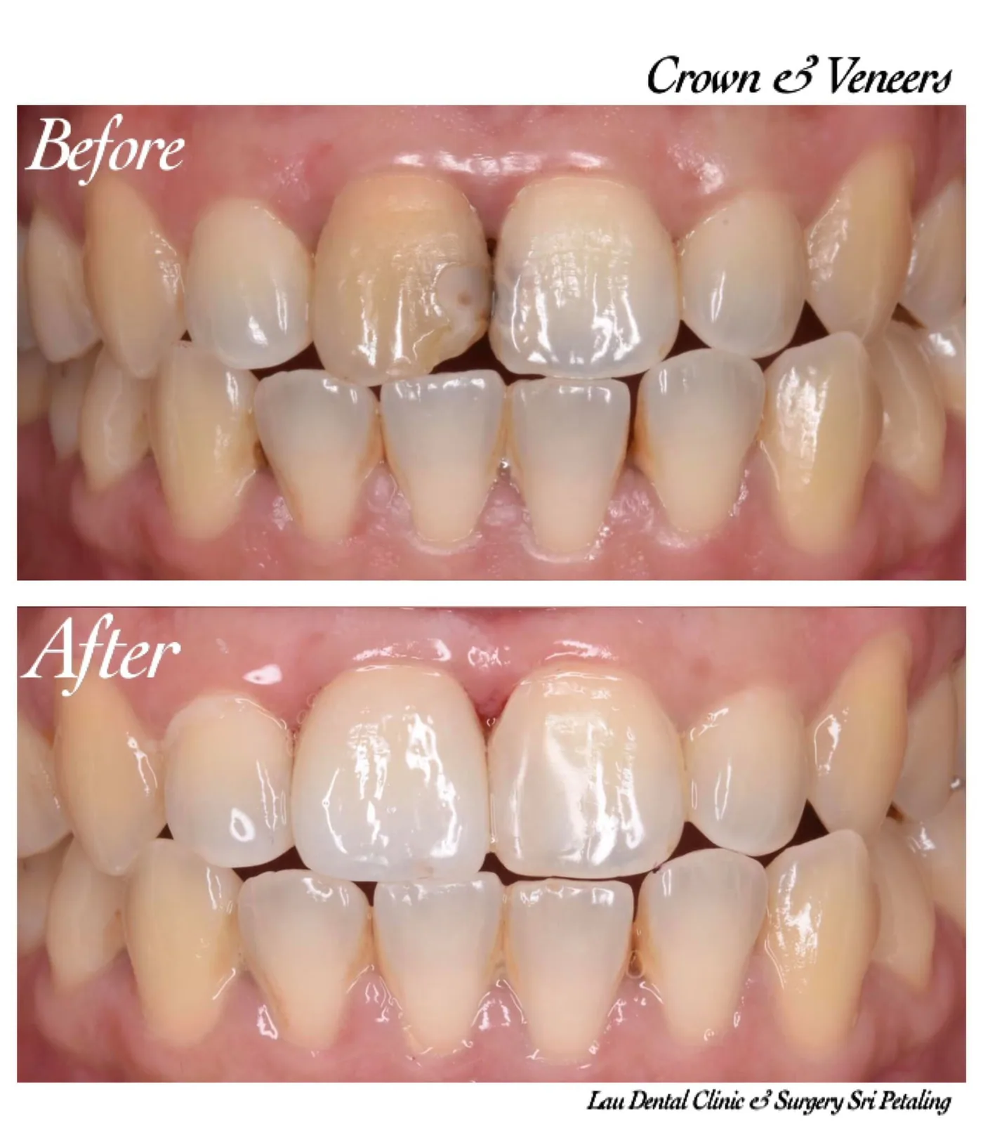 Crown and veneers before and after, brightening discoloured upper front teeth so they blend with the neighbouring natural teeth
