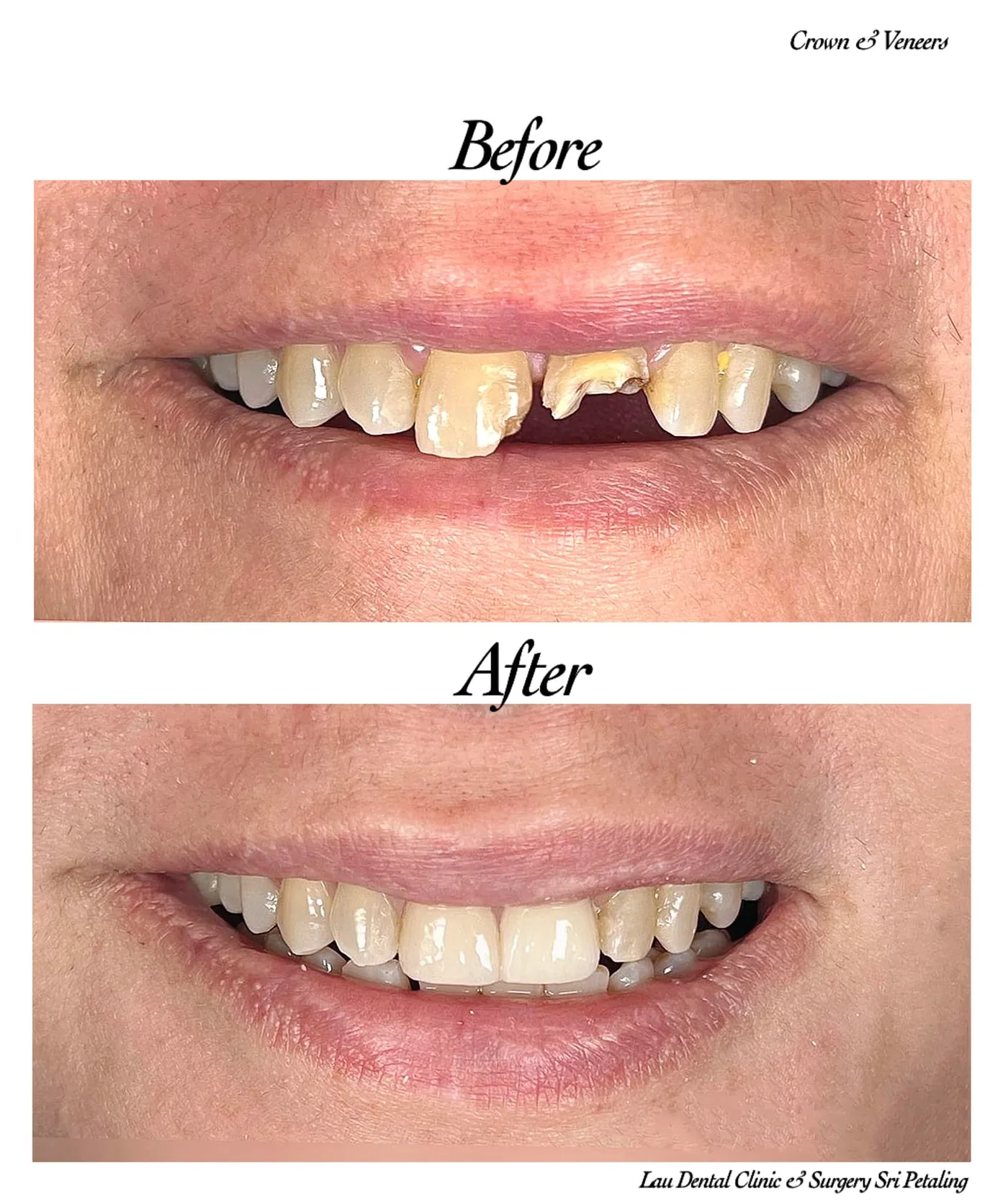 Crowns and veneers before and after, rebuilding a broken and missing front tooth into a complete, natural-looking smile