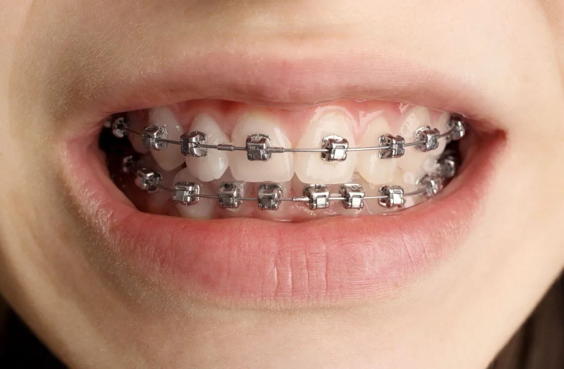 Damon self-ligating metal brackets fitted across the upper and lower teeth, using clips instead of elastics for easier cleaning
