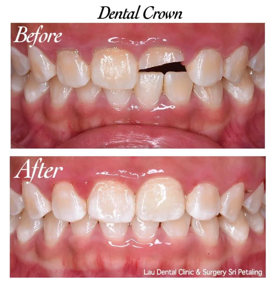 Dental crown before and after, rebuilding a badly chipped upper front tooth into a natural-looking, stronger tooth structure