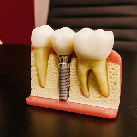 Cutaway jaw model showing a titanium dental implant post beneath a crown