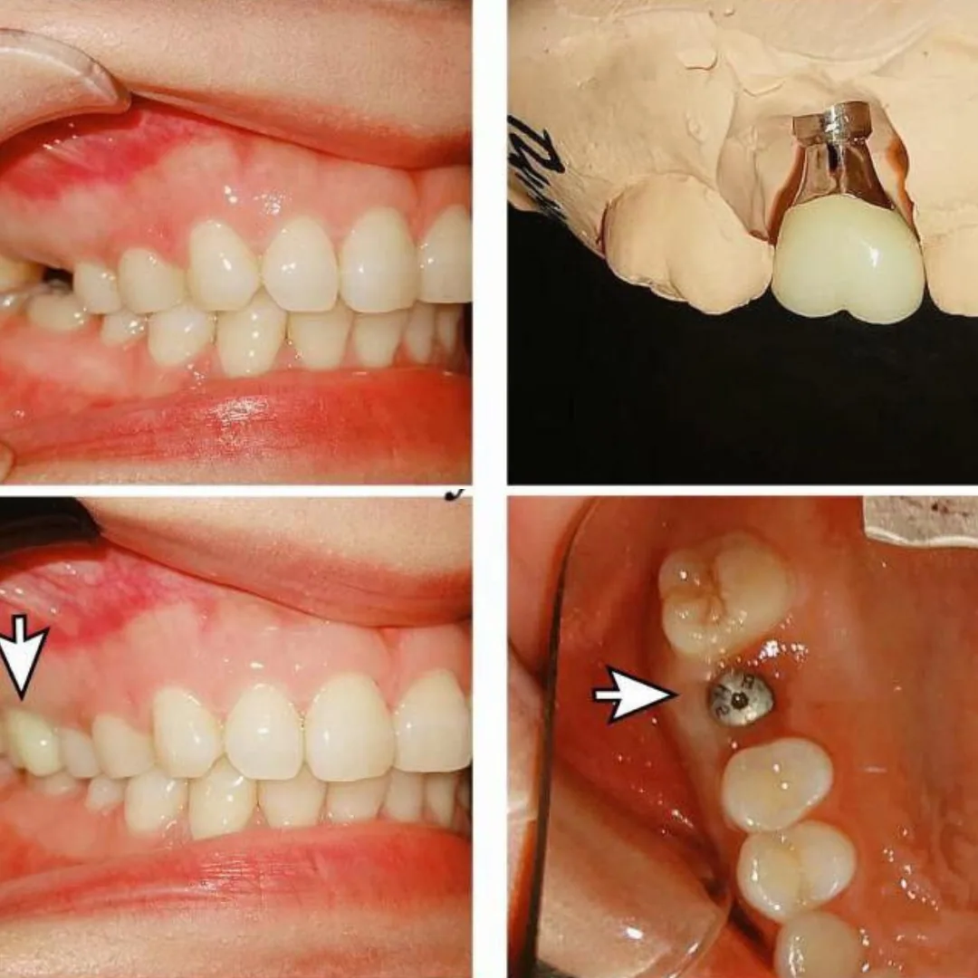 Clinical photographs following a dental implant from placement in the jawbone through to the finished crown replacing the missing tooth