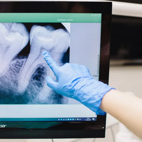 Dentist pointing to the root of a tooth on a dental X-ray