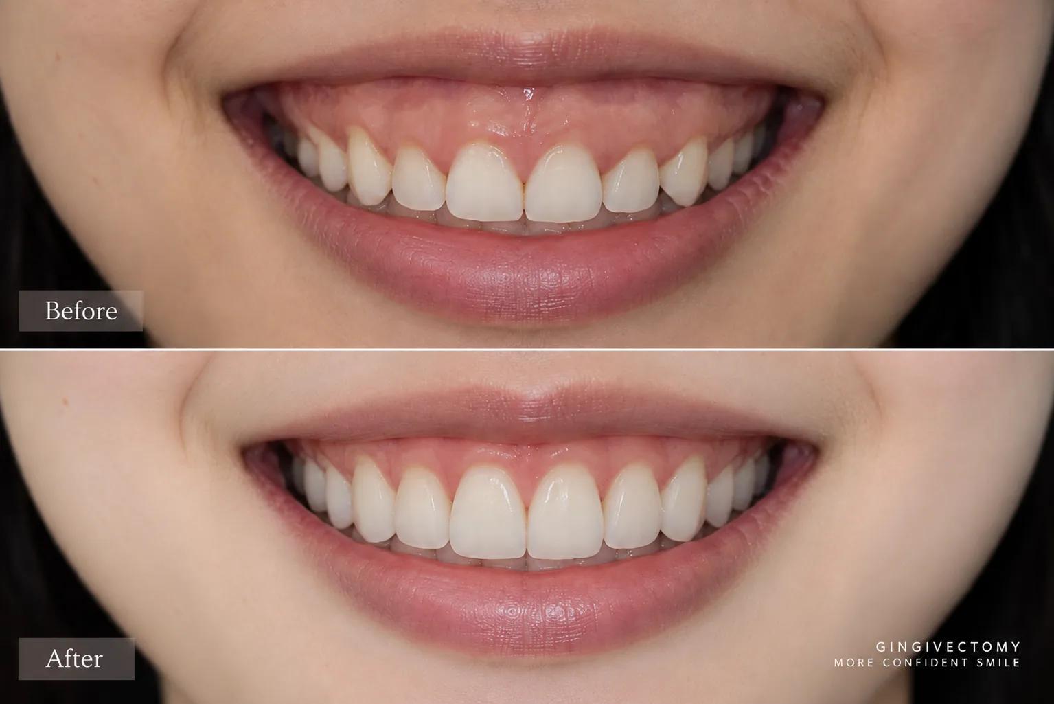 Gingivectomy before and after, with excess gum tissue reshaped so less gum shows and more of each front tooth is revealed when smiling