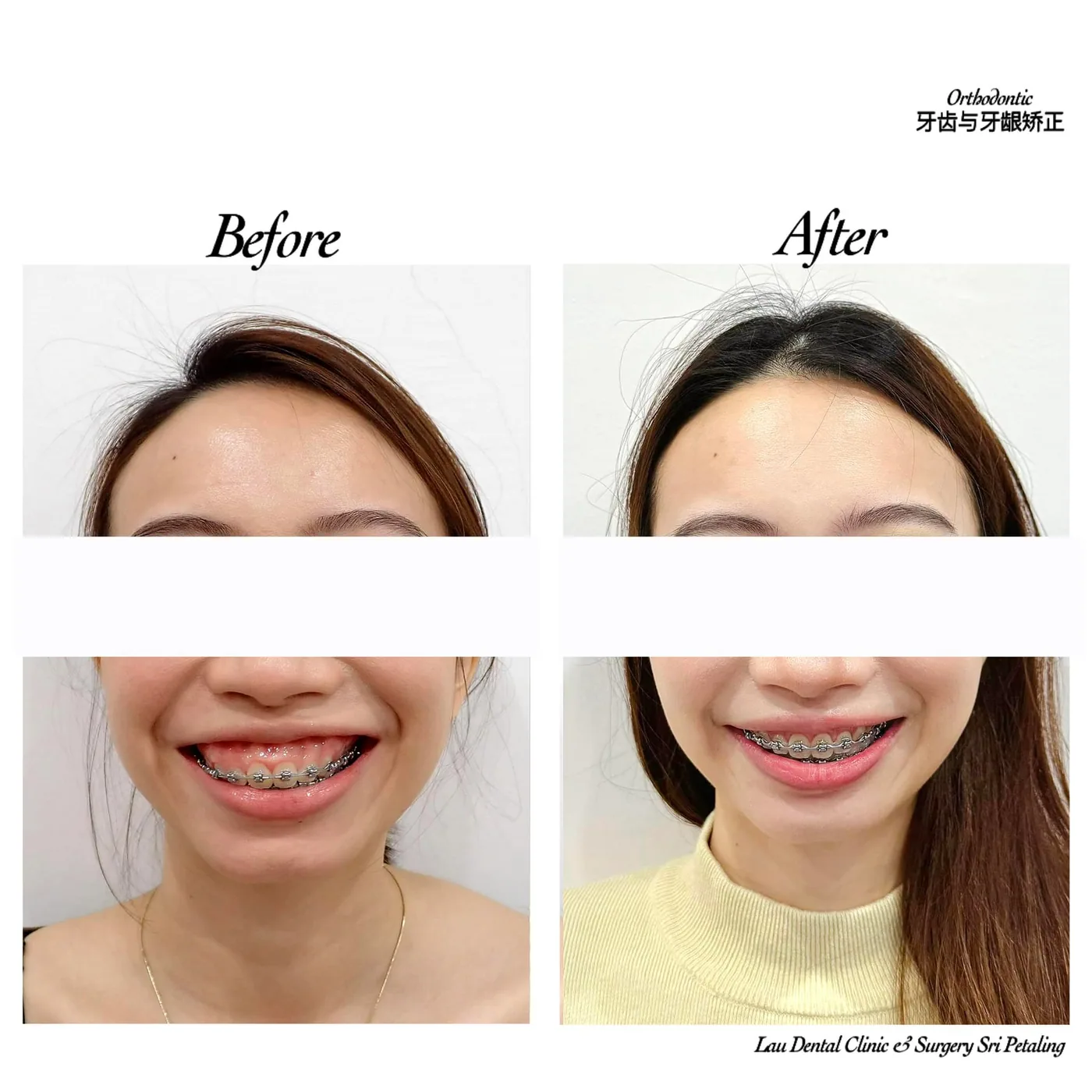 Gummy smile treated alongside braces, before and after, with less gum showing and the front teeth levelled into an even smile