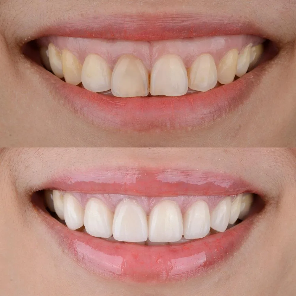 Close-up gum line before and after gummy smile treatment, showing more tooth and less gum for improved smile aesthetics