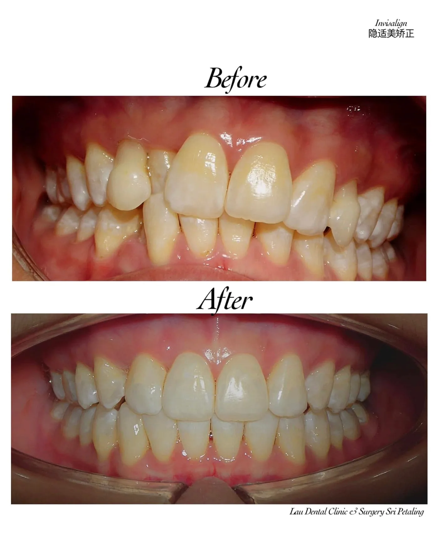 Invisalign clear aligner treatment before and after, straightening crowded, overlapping teeth into a neatly aligned arch