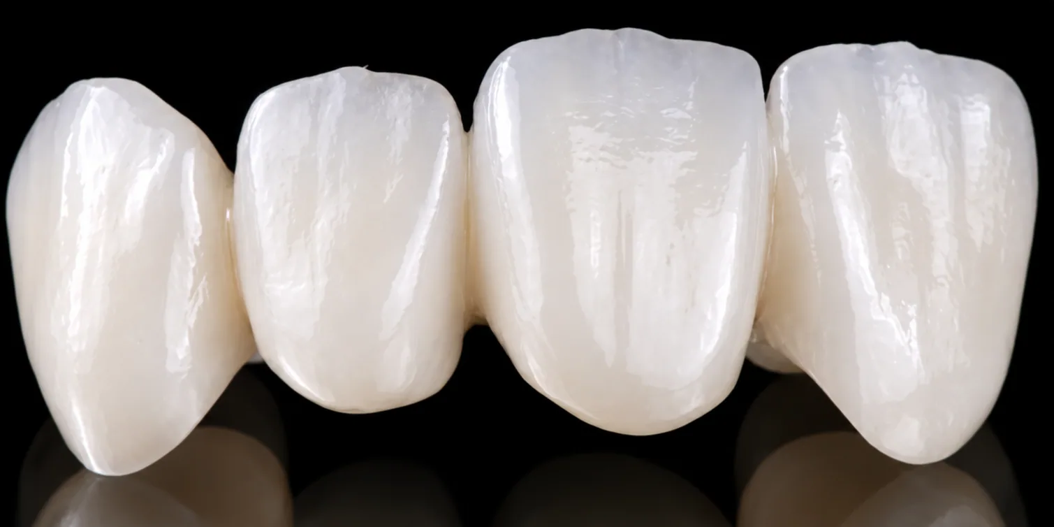 Four IPS e.max all-ceramic front crowns, the metal-free lithium disilicate option with lifelike translucency at the incisal edges