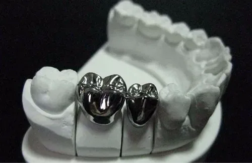 Full metal dental crowns fitted on a study model, the strongest option for back teeth where chewing pressure is highest