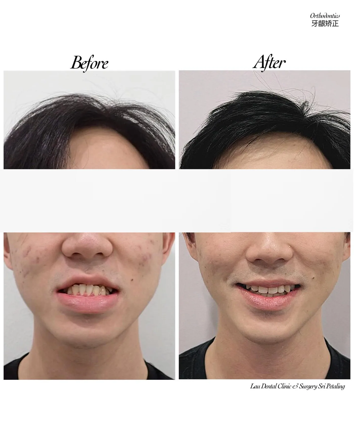 Orthodontic treatment before and after, drawing protruding upper front teeth back into line for improved bite and facial balance