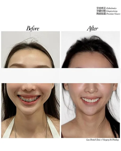 Braces, gingivectomy and porcelain veneers before and after, turning crowded teeth and a heavy gum line into a full smile makeover