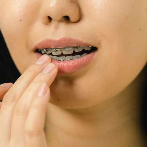 Close-up of a woman showing her metal braces