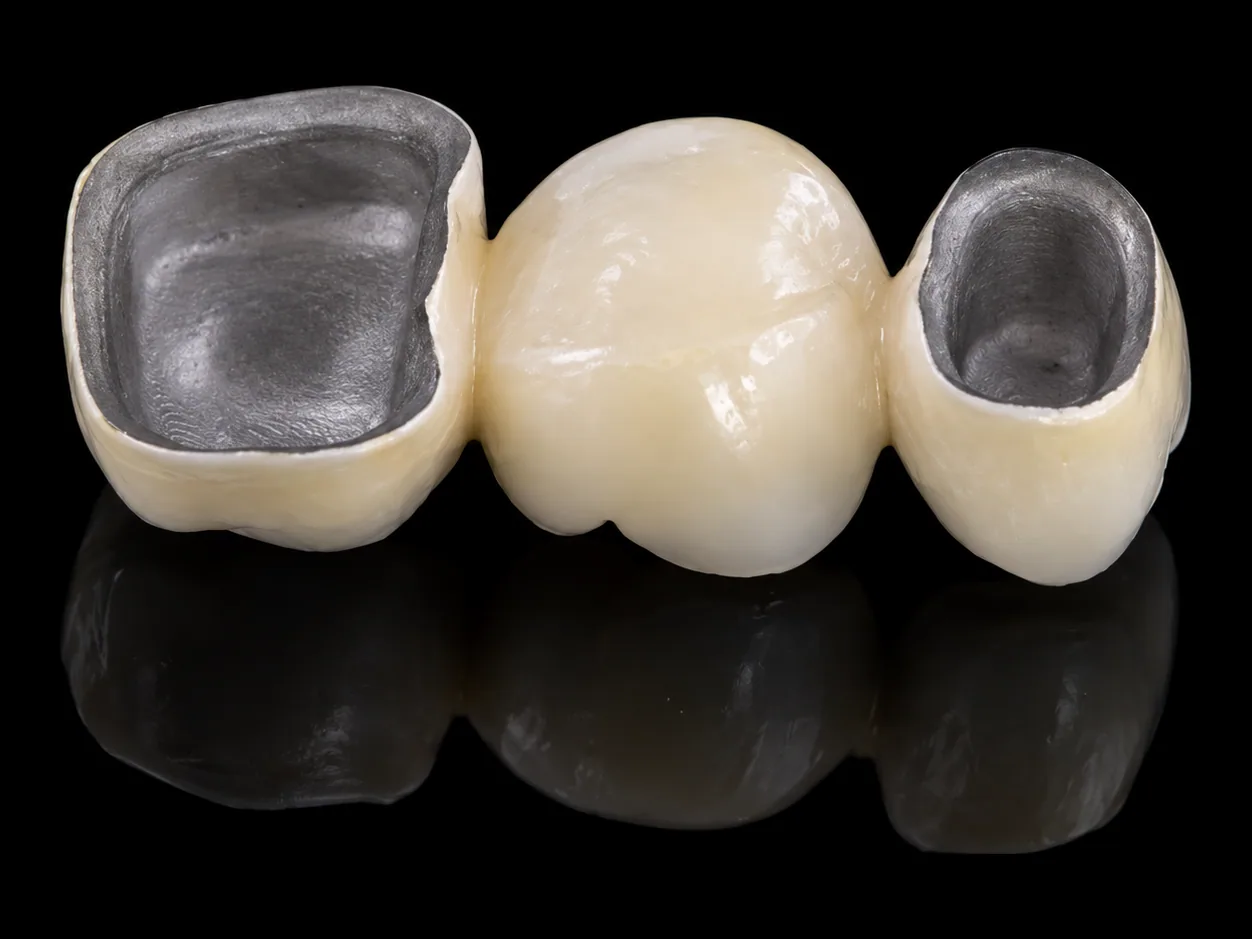 Underside of a three-unit porcelain-fused-to-metal bridge, showing the metal substructure inside the crowns beneath the tooth-coloured porcelain