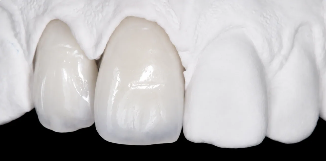 Porcelain-fused-to-zirconia front crowns on a plaster model, layered for a natural shade and translucency at the incisal edge
