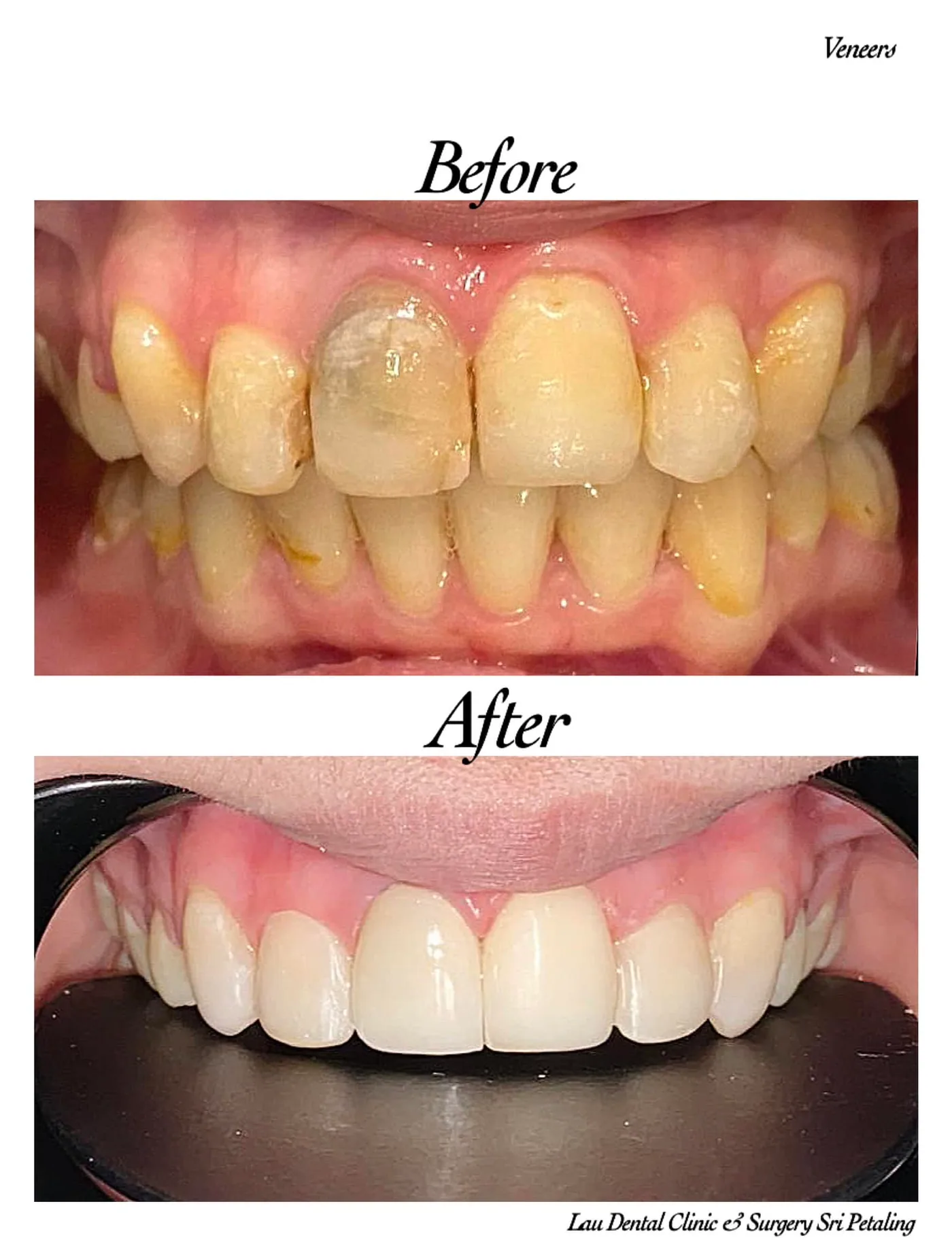 Porcelain veneers before and after, transforming a dark discoloured front tooth and stained neighbours into a bright, even smile