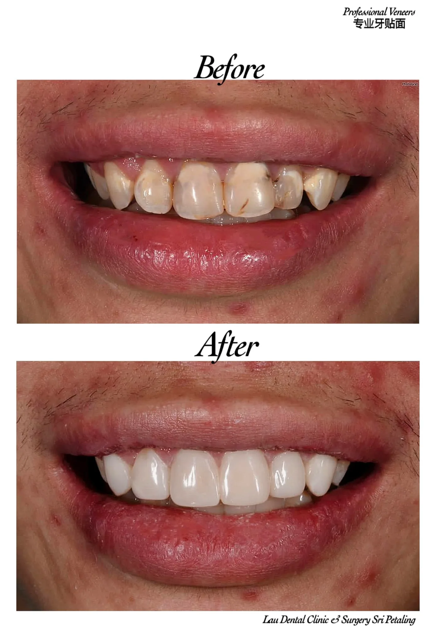 Porcelain veneers before and after, reshaping worn and uneven upper teeth into a full, evenly proportioned smile