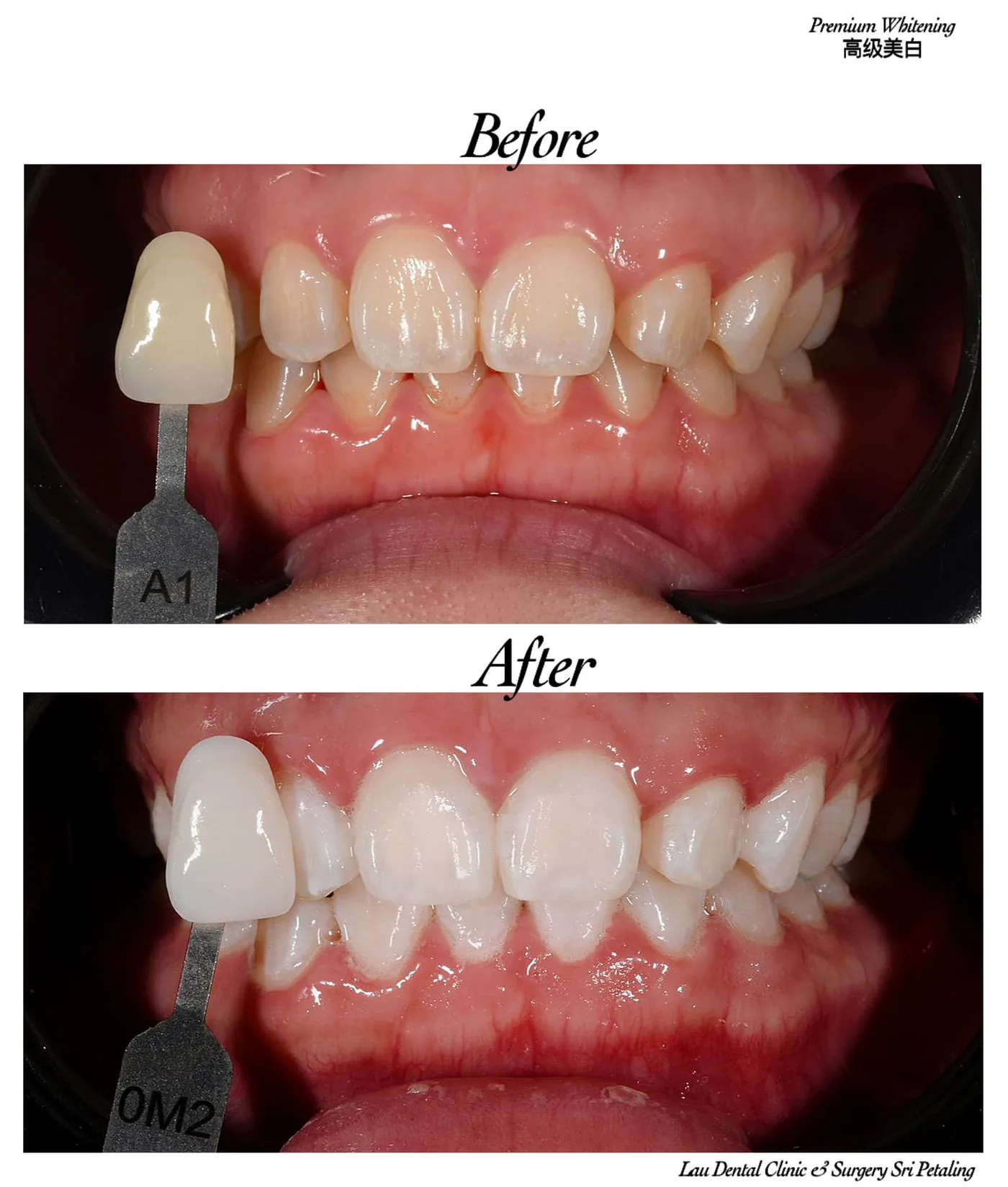 Premium teeth whitening before and after, taking already light A1 teeth to a brighter 0M2 shade for a striking result