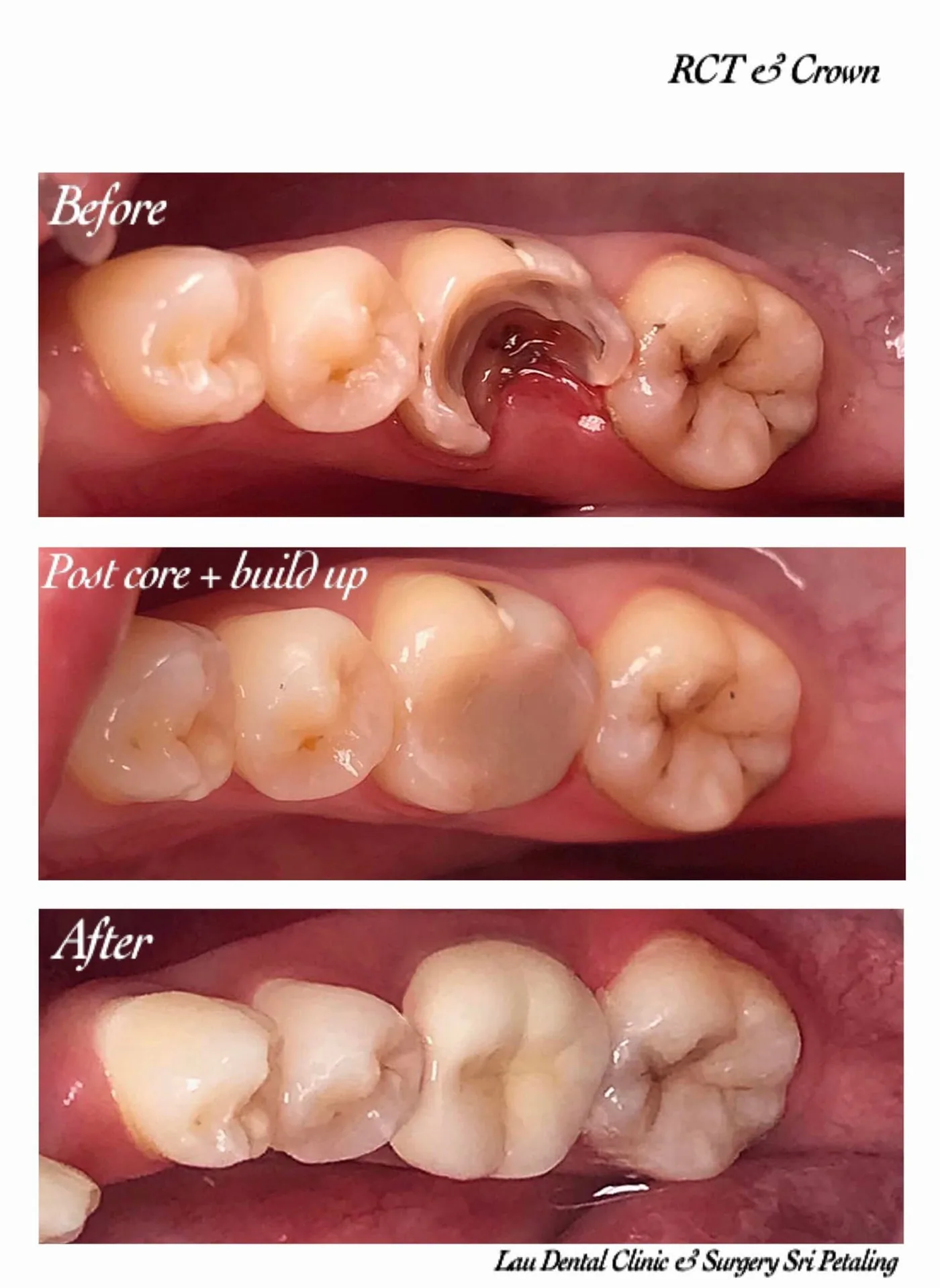 Root canal with post, core build-up and crown, restoring a deeply decayed molar into a fully functional back tooth