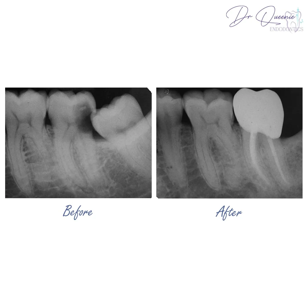 Before and after X-rays of a root canal treated molar, showing the sealed canals and the crown that protects the restored tooth