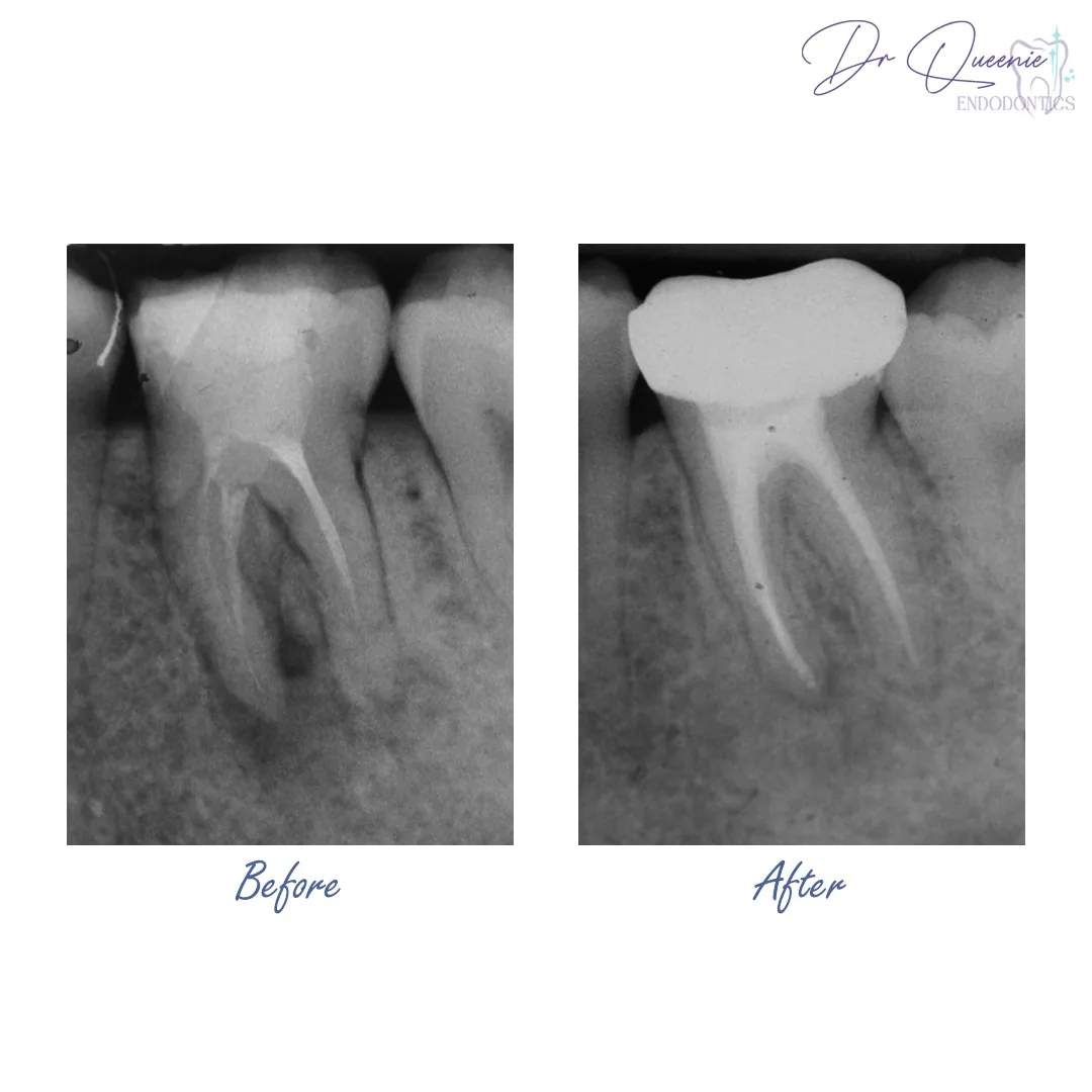 Live microscope view of a root canal on the treatment room screen, letting the patient see the infected tooth being cleaned out