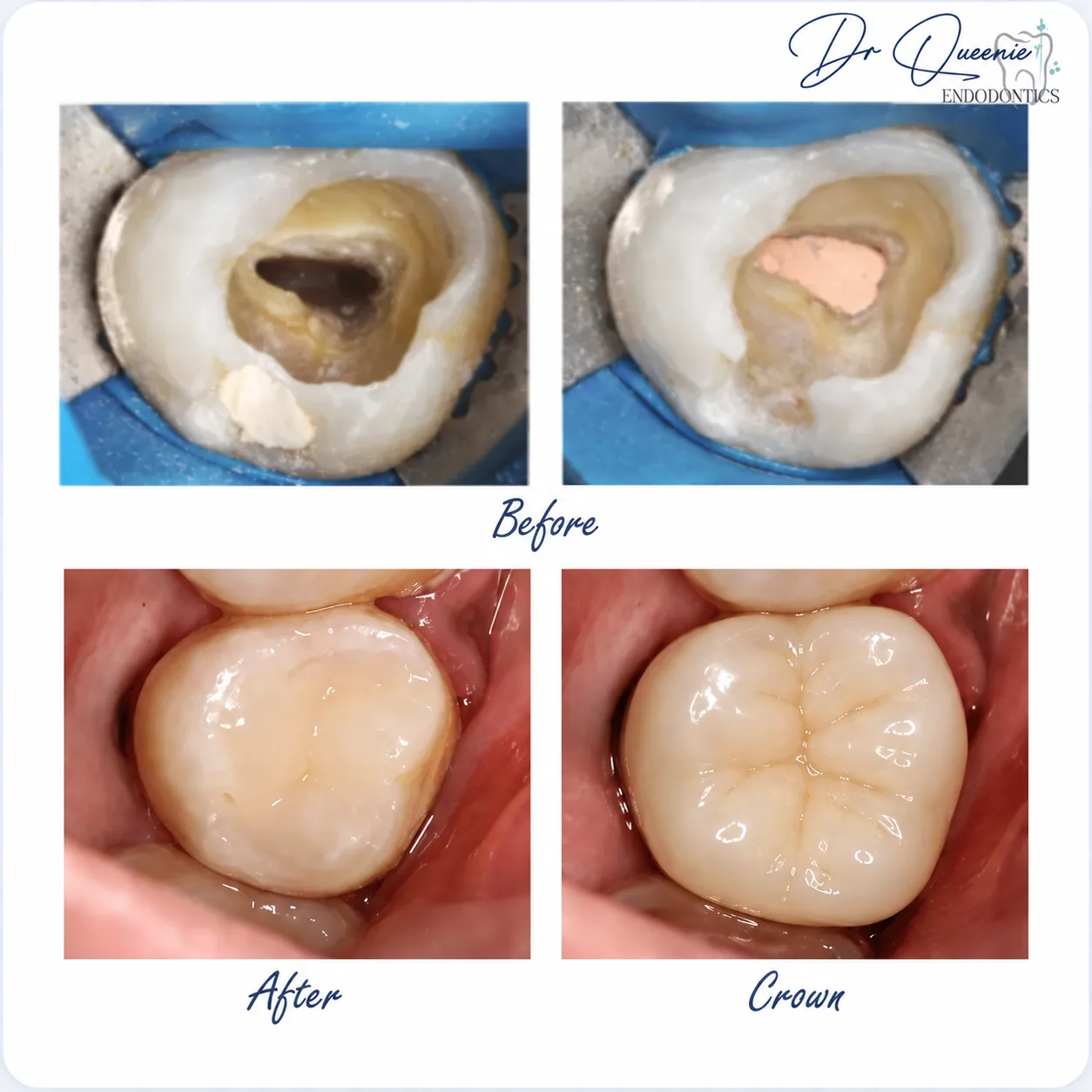 Root canal treatment stages on a molar — the infected pulp chamber opened and cleaned, the tooth sealed, then protected with a crown
