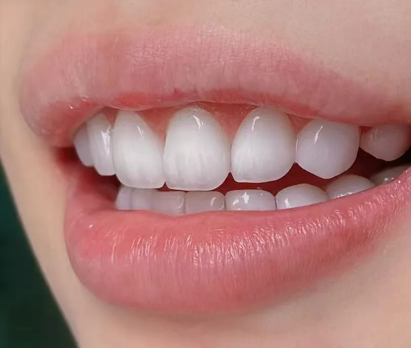 Close-up of a finished smile design, with porcelain veneers giving bright, evenly shaped upper front teeth and a natural gum line