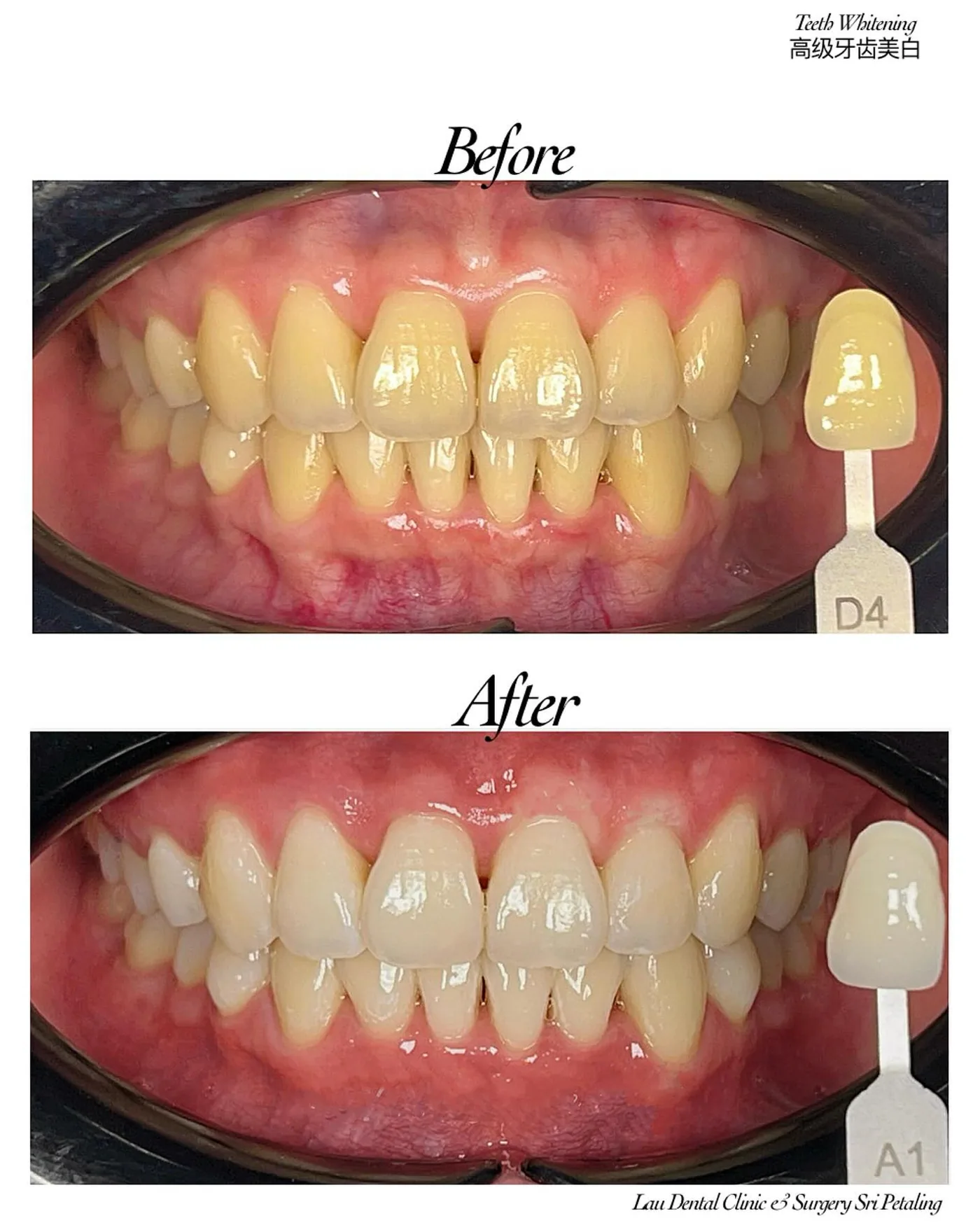 Professional teeth whitening before and after, lifting yellowed teeth from shade D4 to A1 for a noticeably brighter smile