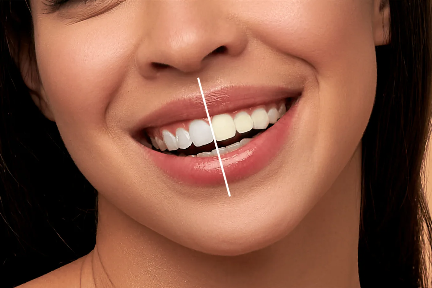 Smile split down the middle to compare whitened and untreated teeth, showing the difference professional whitening makes