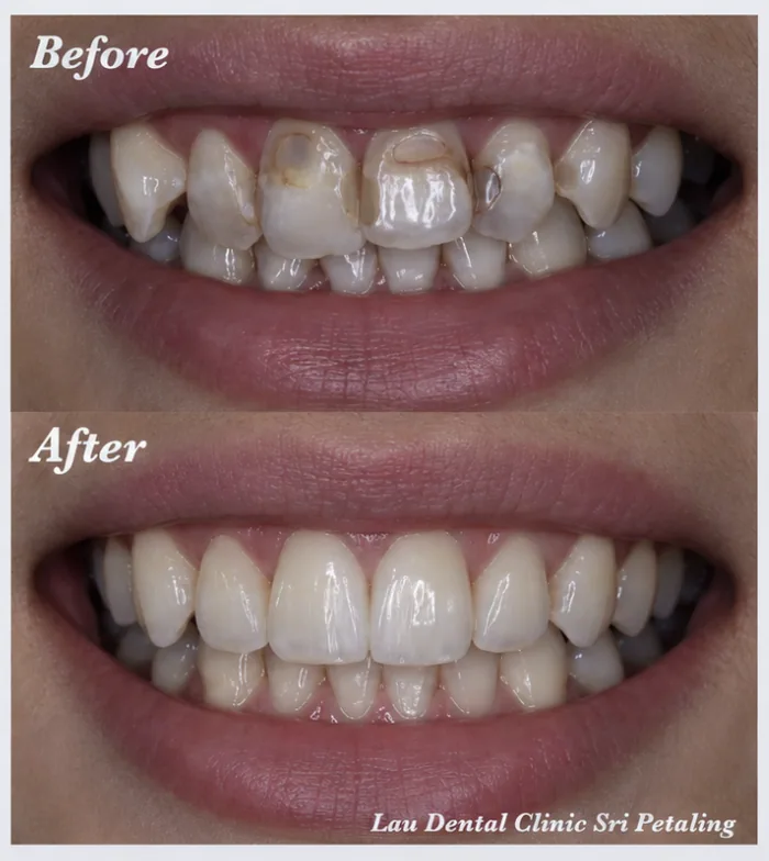 Veneers before and after, rebuilding broken, worn and discoloured upper front teeth into an even, brighter and healthier-looking smile