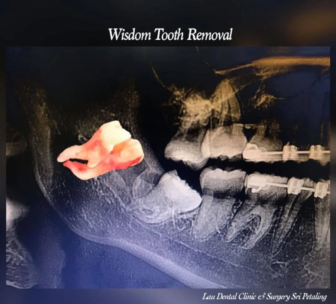 Extracted wisdom tooth shown against the X-ray that identified it during braces treatment, removed to protect the aligned teeth