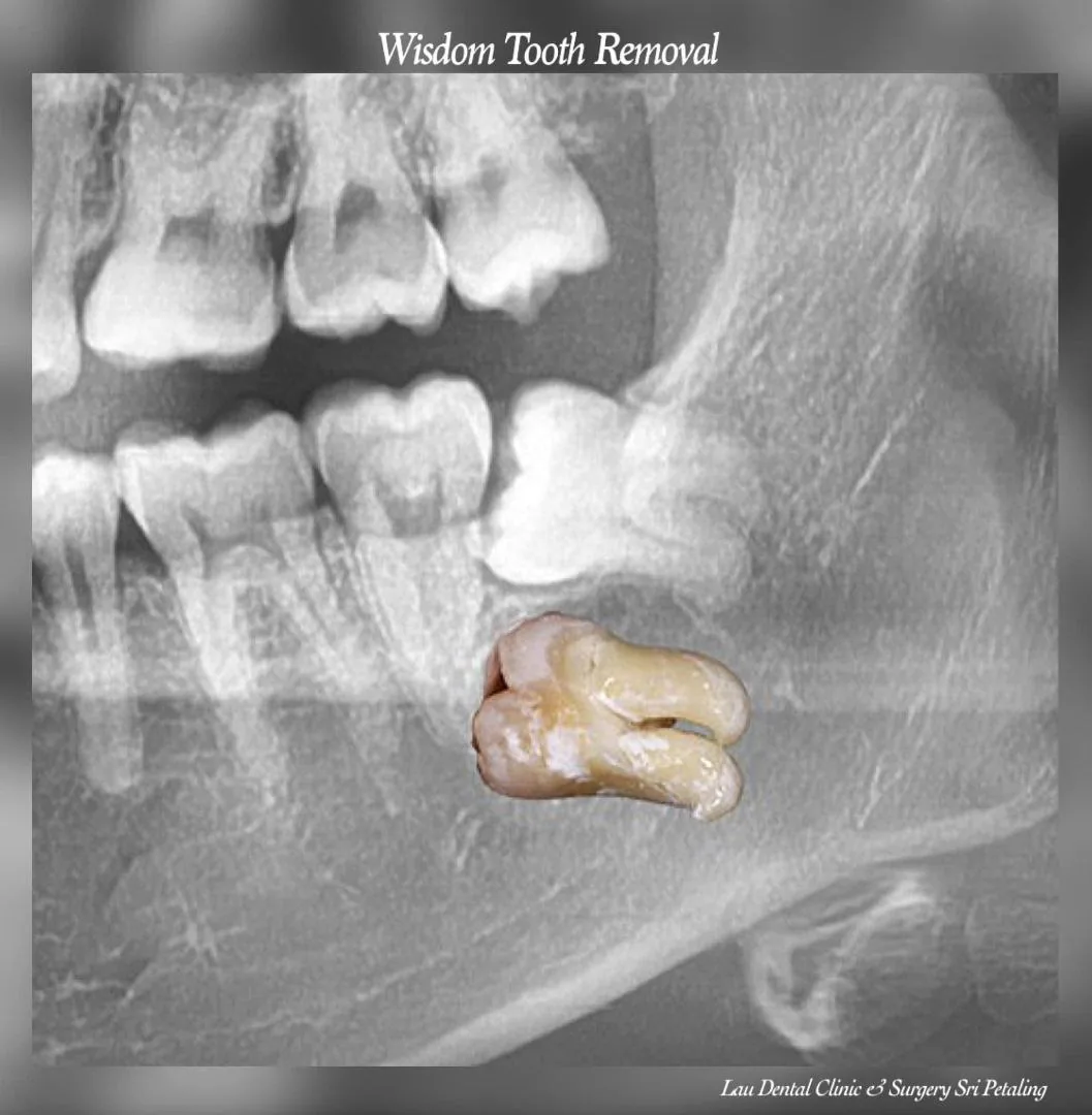 X-ray of an impacted wisdom tooth pressing against the molar in front of it, the usual cause of pain and swelling at the back