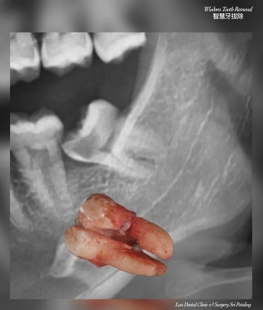 Removed multi-rooted wisdom tooth alongside its pre-operative X-ray, showing why surgical extraction was the safer option