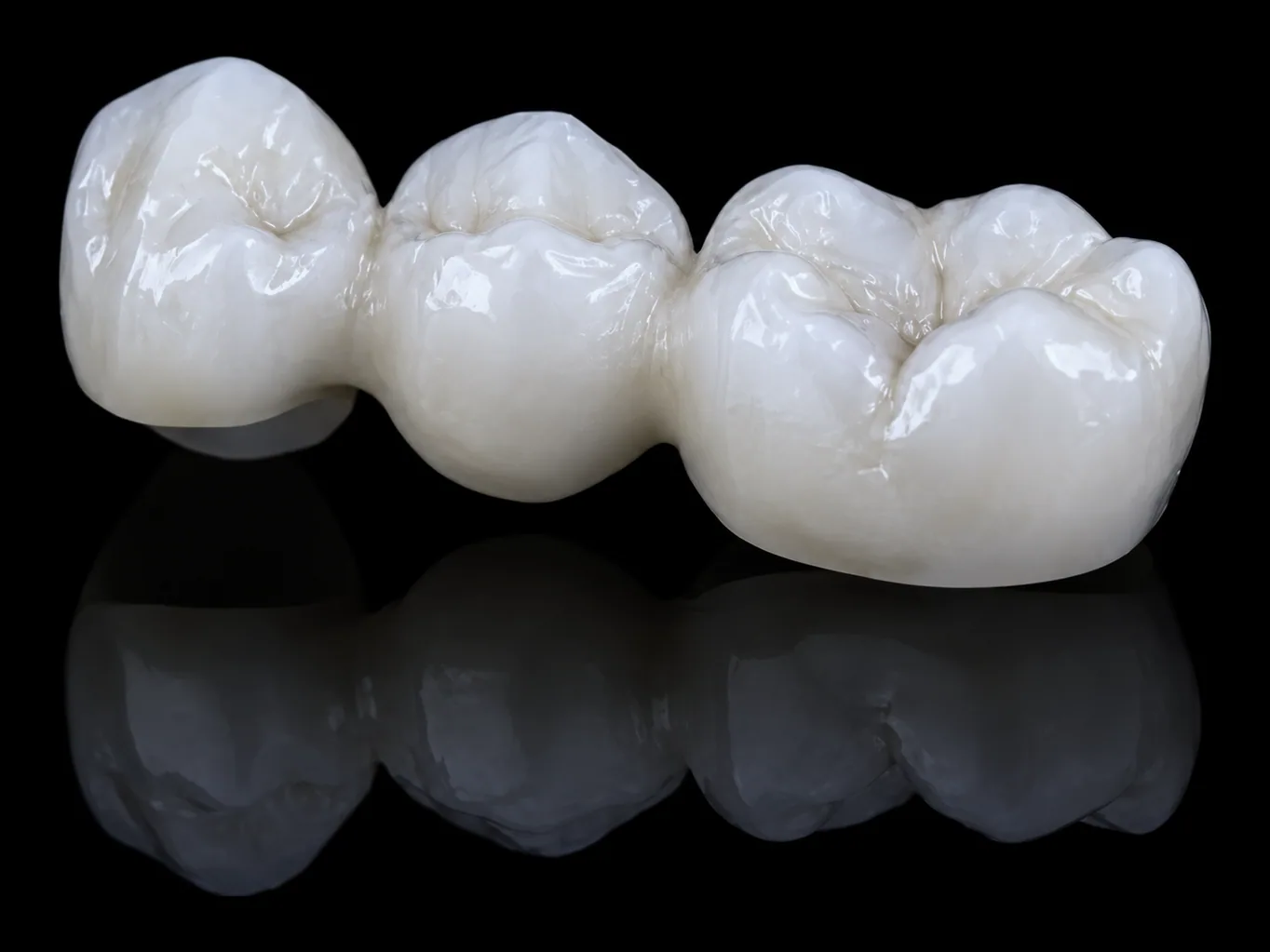 Close-up of a three-unit zirconia bridge for the molars, the crack-resistant, gum-friendly ceramic used for long-lasting back-tooth restoration