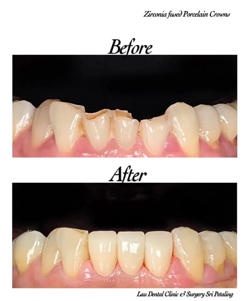 Zirconia-fused porcelain crowns before and after, restoring worn and chipped lower front teeth to an even, durable edge
